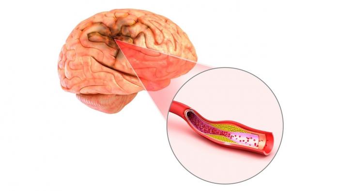 Os avances en investigación de cavernomas do Laboratorio de Bioloxía Vascular do CiMUS reciben financiamento de Sumo Valor, unha iniciativa da Vicerreitoría de Planificación, Tecnoloxías e Sustentabilidade co apoio do Consello Social da USC