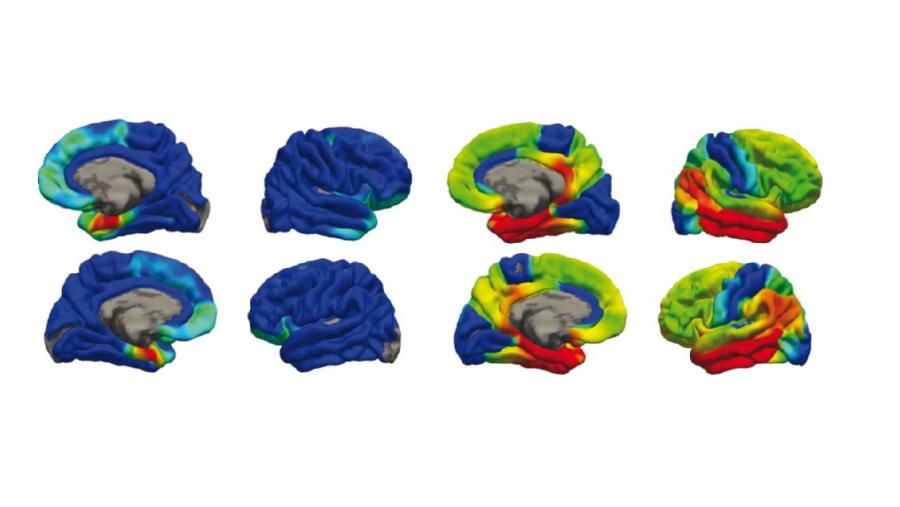 Detección mediante PET da acumulación cerebral da proteína tau en pacientes con PART (esquerda) e con enfermidade de Alzheimer (dereita) Detección mediante PET da acumulación cerebral da proteína tau en pacientes con PART (esquerda) e con enfermidade de Alzheimer (dereita)